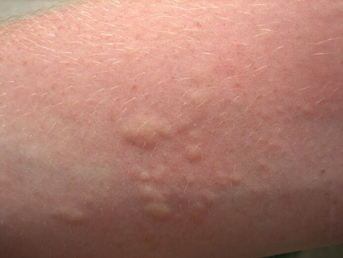 Allergic itchy skin rashes may be symptoms of ascariasis