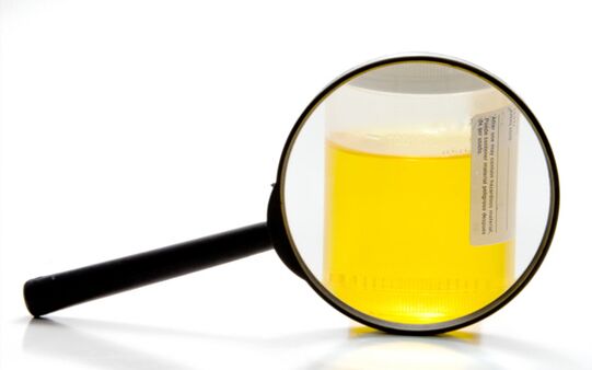 Urine examination to diagnose schistosomiasis