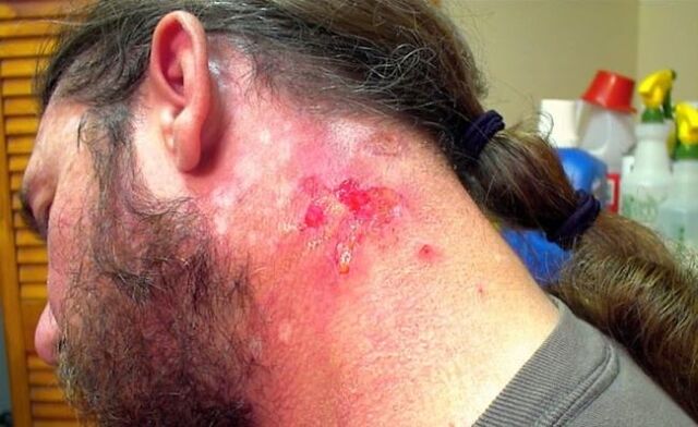 Bleeding wounds in the neck with Morgellons virus